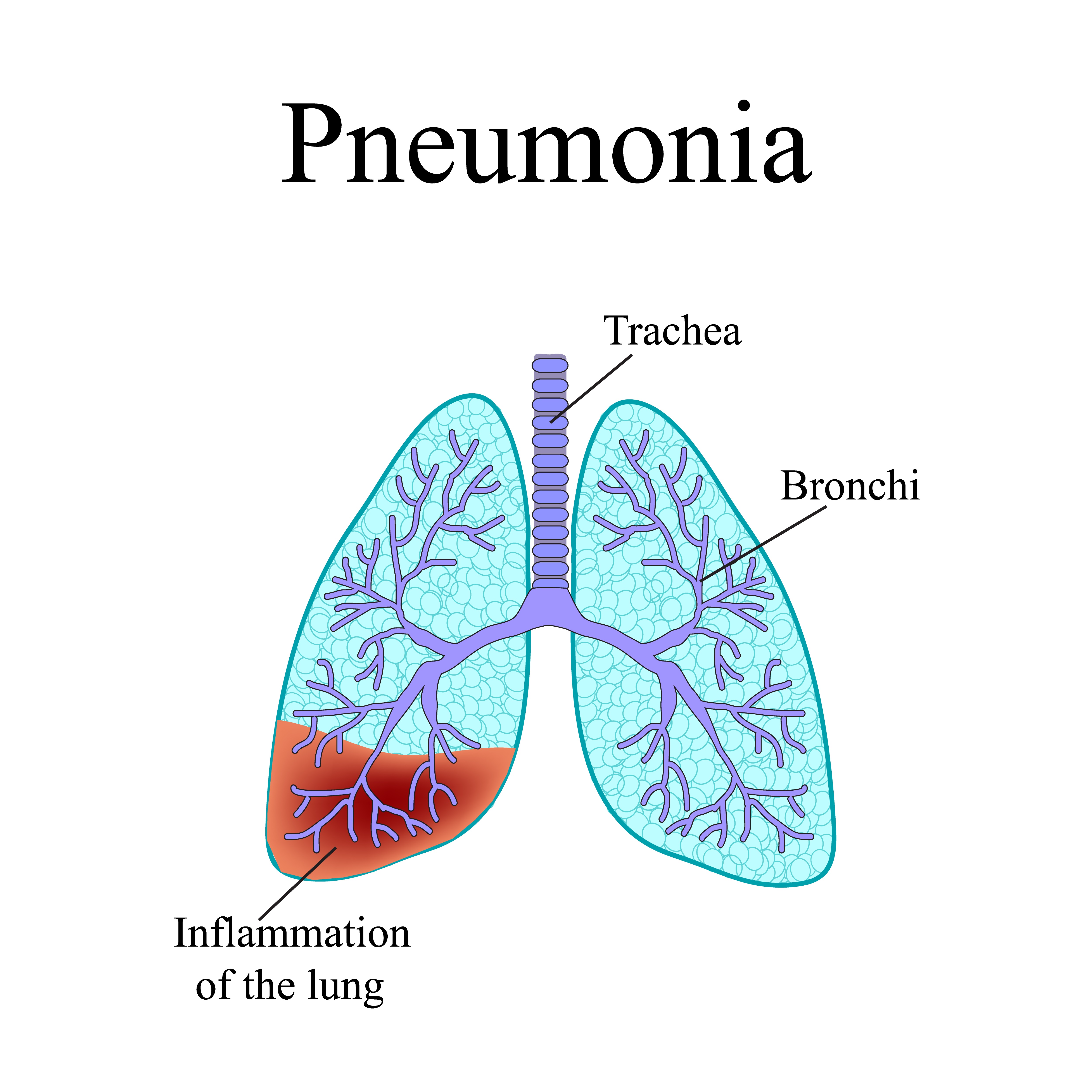 Пневмония рисунок