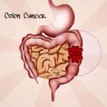 Colorectal Cancer: 5 Facts to Know