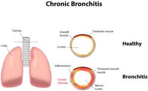 Chronic Obstructive Pulmonary Disease: 9 Complications