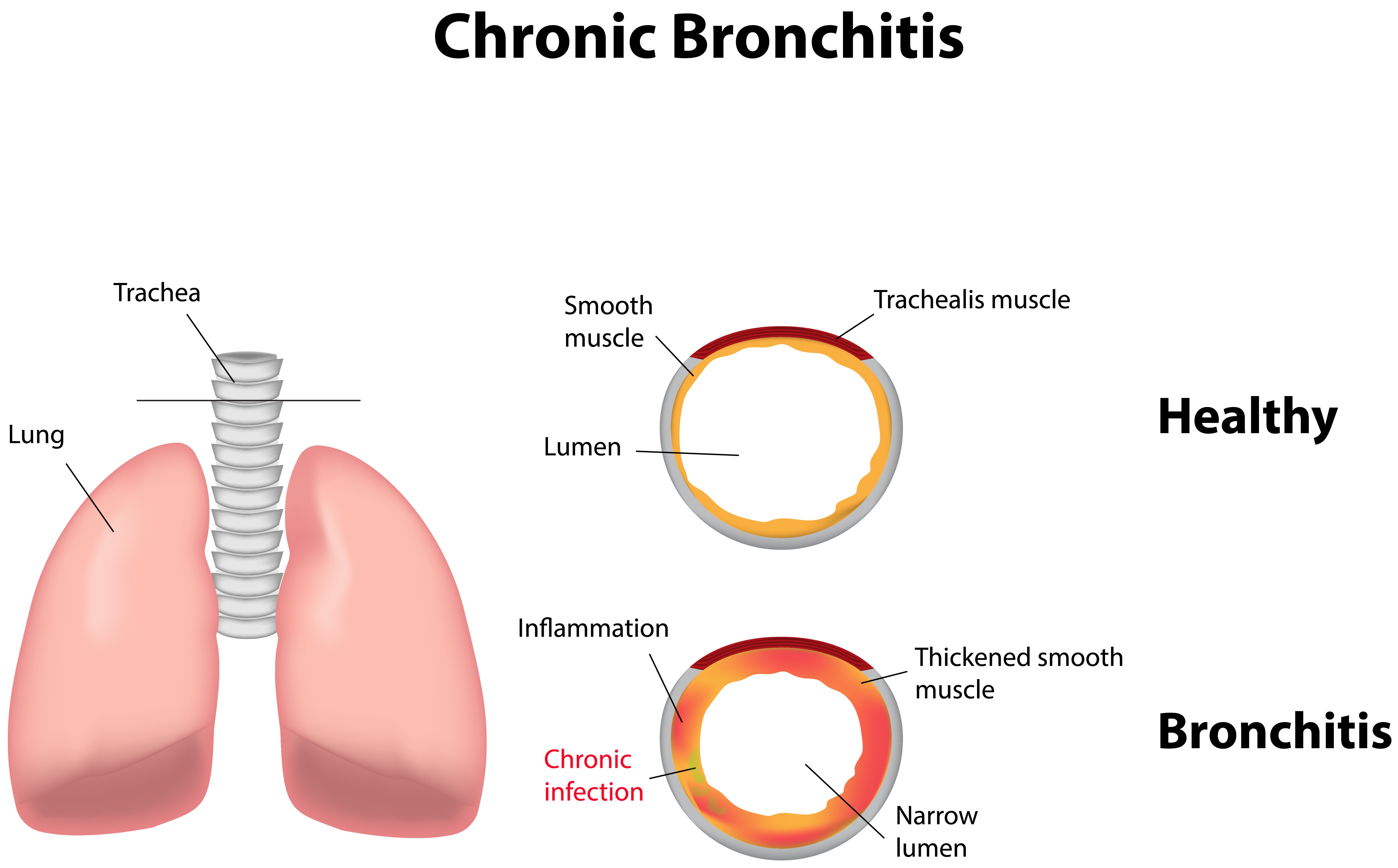 Chronic Bronchitis Jay Harold