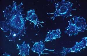 9 Cancer Stats to Know & What Is Metastatic Cancer?